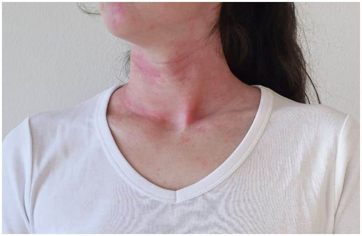 Allergic skin reaction on face and neck