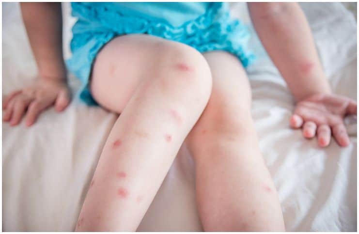 Bed Bug Bites vs Mosquito Bites – Facts, Symptoms, Treatment, Prevention, Tips a