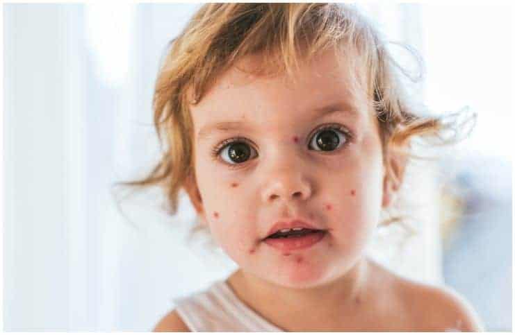 Measles vs Chicken Pox – Facts, Symptoms, Causes, Duration, Treatment a