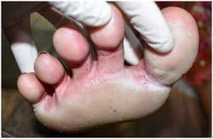 Athlete's Foot On Hands - Symptoms, Causes, Treatment, Prevention a