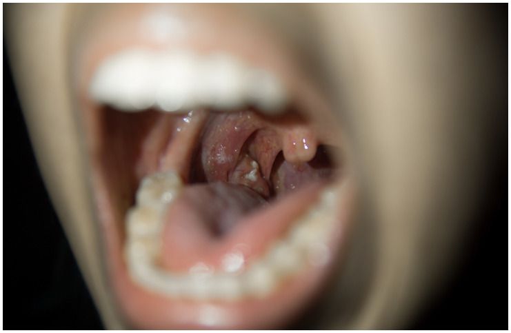 Cryptic Tonsils – Symptoms, Causes, Treatment, Removal, Prevention a