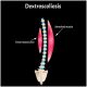 How Dextroscoliosis Changes Your Entire Life Forever