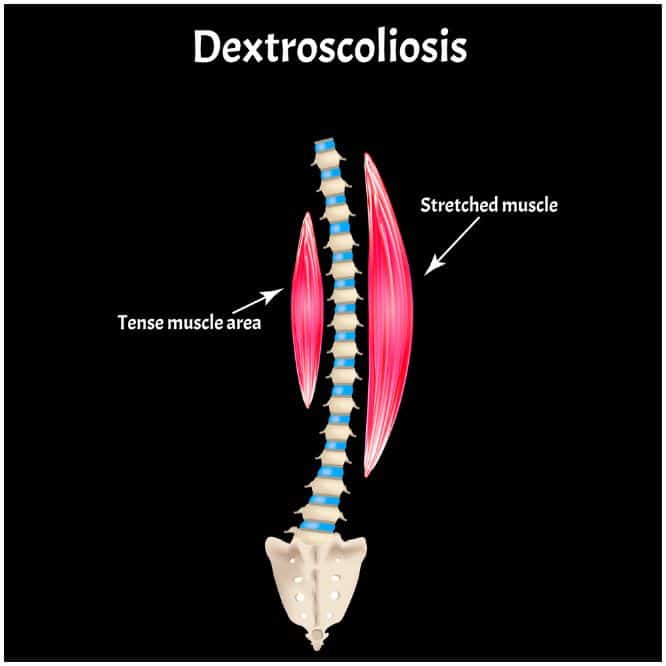 Dextroscoliosis vs Levoscoliosis – Symptoms, Causes, Treatment, Prevention a