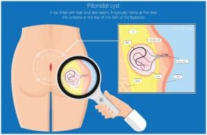 Pilonidal Cyst - Home Treatment, Causes, Symptoms, Prevention