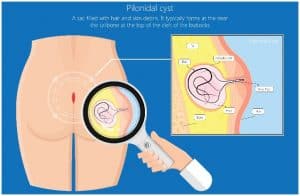 Pilonidal Cyst - Home Treatment, Causes, Symptoms, Prevention