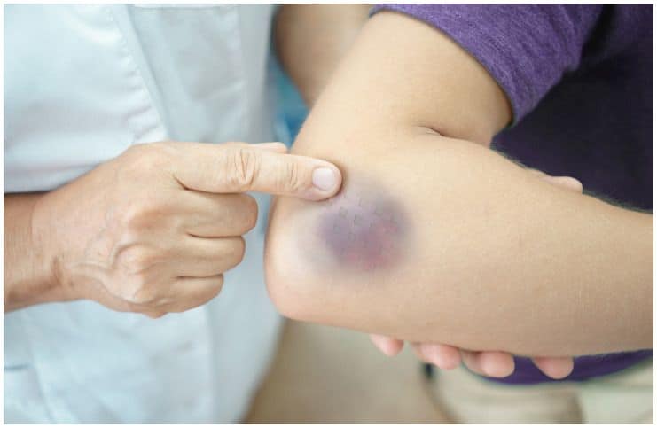 10 Essential Oils For Bruising (Ecchymosis) a