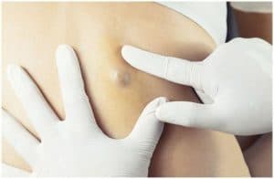10 Essential Oils For Blisters, Sebaceous Cysts, And Abscesses a