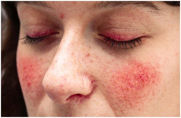 20 Interesting Facts About Rosacea And Its Causes, Symptoms, Diagnosis, Treatment, Prevention, Statistics a