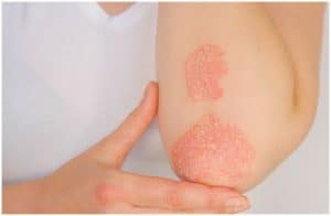 Ringworm vs Psoriasis - Causes, Symptoms, Treatment, Differences a