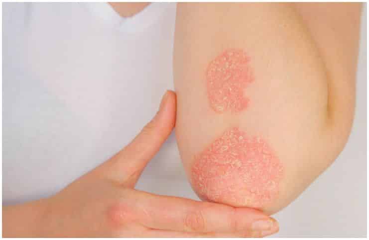 Ringworm vs Psoriasis - Causes, Symptoms, Treatment, Differences a