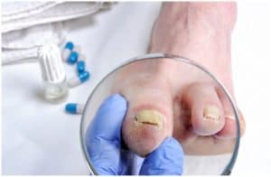 Kerydin vs Jublia - Which Is Better For Treating Onychomycosis a