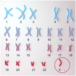 List Of Celebrities With Turner Syndrome (Linda Hunt?)