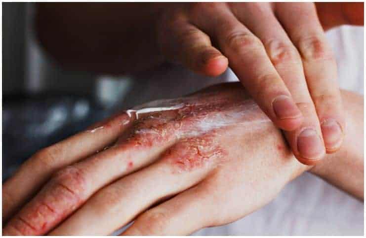 Scabies vs Eczema - Differences in Symptoms, Causes, and Treatment
