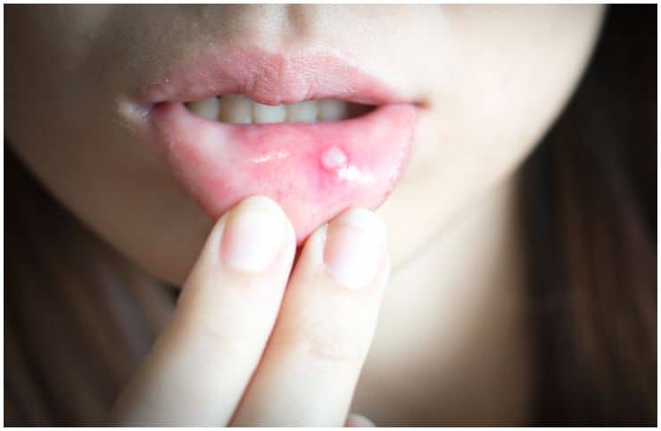 Orabase vs Orajel – Which Is Better For Canker Sores & Toothache a
