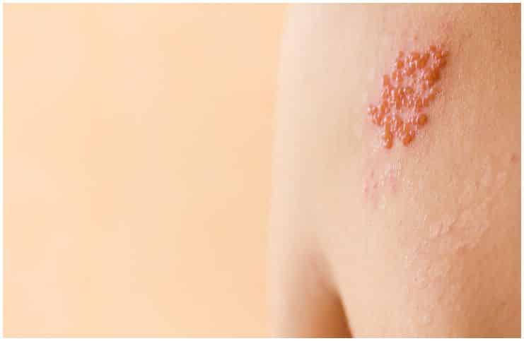 Valtrex vs Zovirax For Shingles – Differences & Side Effects a