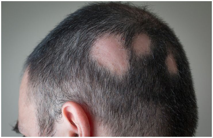 Alopecia Areata vs Tinea Capitis - Differences