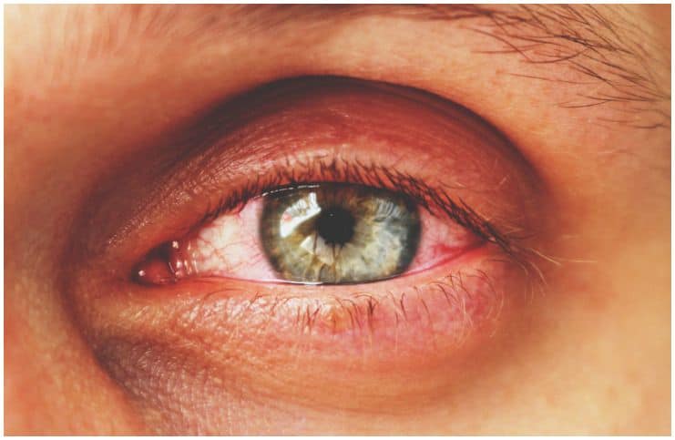 Episcleritis vs Conjunctivitis (Pinkeye) - Knowing the Difference