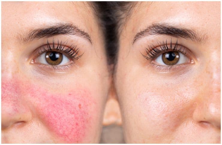 Malar Rash vs Rosacea – Causes & Differences