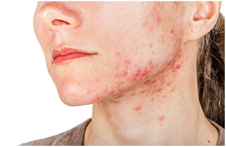 Nodular Acne vs Cystic Acne – Treatment Options & Differences