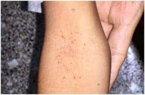 Petechiae vs Purpura - Causes & Differences