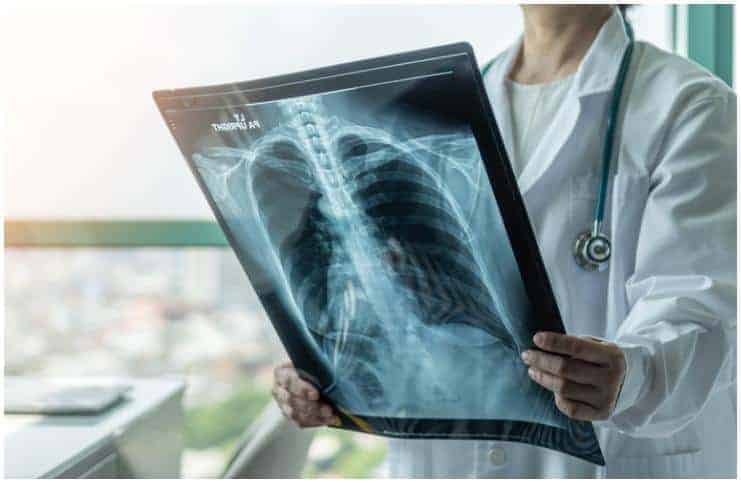 Pulmonary Edema vs Pleural Effusion – Causes & Differences a