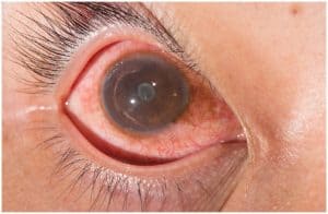 Uveitis vs Iritis - Differences