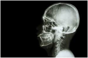 Dent In Skull (Top of the Head Forehead Back of the Head) - Causes