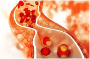 HDL Cholesterol vs LDL Cholesterol - Comparison of Differences