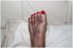 10 Essential Oils For Morton's Neuroma + Home Remedies