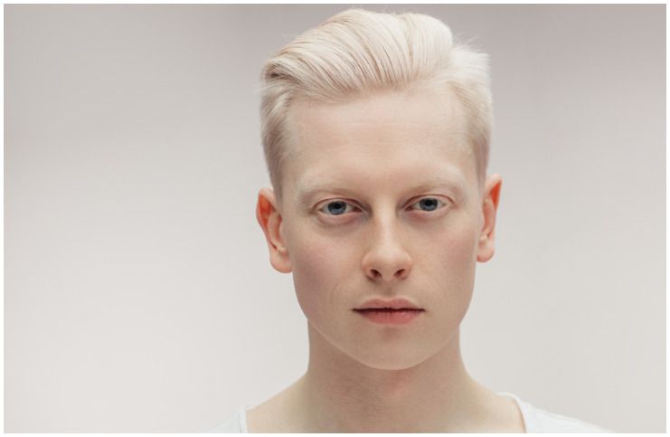 10 Famous People With Albinism (Nastya Zhidkova?)