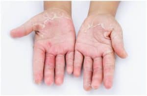 Contact Dermatitis vs Scabies – Differences