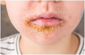 Impetigo vs Herpes - Differences & Treatment