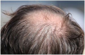 Telogen Effluvium vs Male Pattern Baldness Symptoms Causes