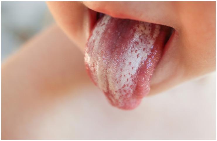 Newborn Thrush vs Milk Tongue - Symptoms, Causes, Differences