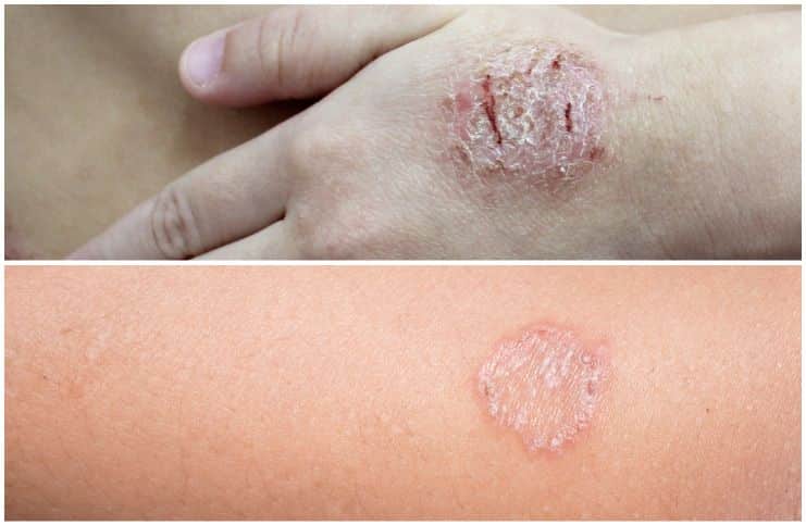 Nummular Eczema vs Ringworm - Symptoms, Causes, Diagnosis, Treatment, Prevention