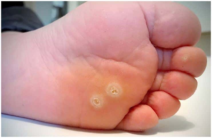 Plantar Warts vs Corns - Differences