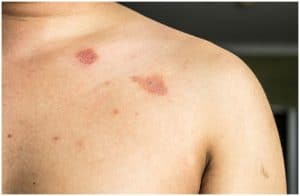 Nummular Eczema vs Ringworm - Symptoms, Causes, Diagnosis, Treatment ...