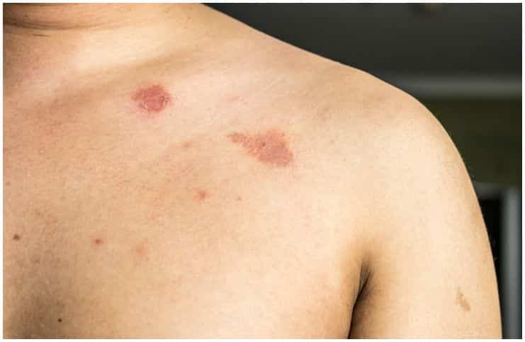 Ringworm on chest
