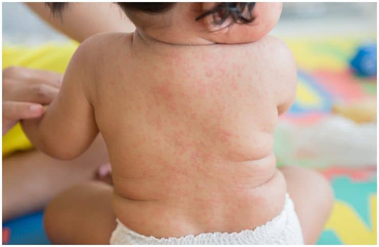 Roseola vs Fifth Disease – Symptoms, Causes, Differences