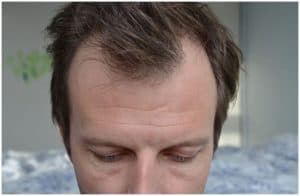 Telogen Effluvium vs Male Pattern Baldness Symptoms Causes
